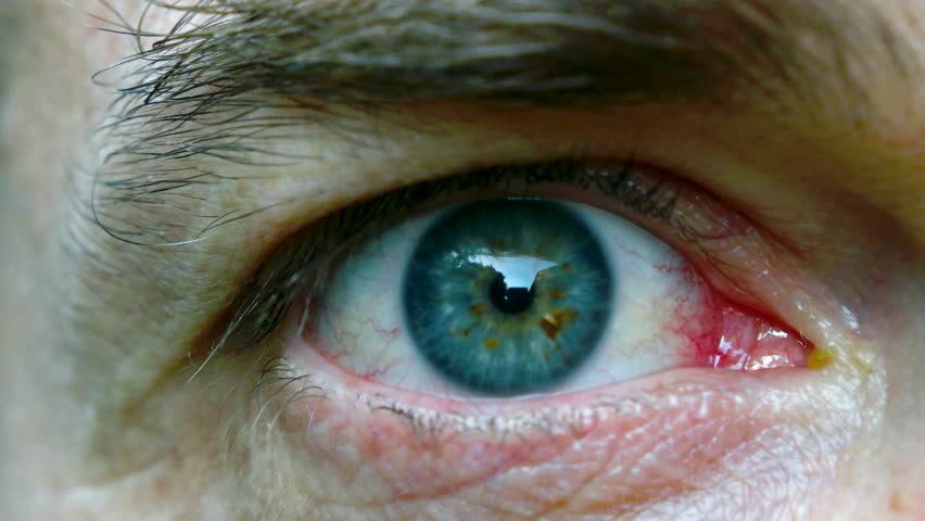 Mucus in Eye What Causes Eye Boogers and How to Treat It