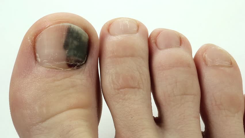 Trauma Of Toenail. Subungual Hematoma. Bruise Under The Nail Of Big Toe ...